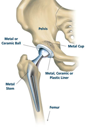 What will my total hip replacement look like