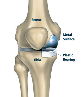 What will my partial knee replacement look like