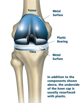 What will my total knee replacement look like